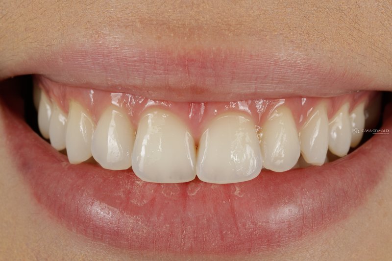 Clareamento dental em Itapema — resultado após o tratamento