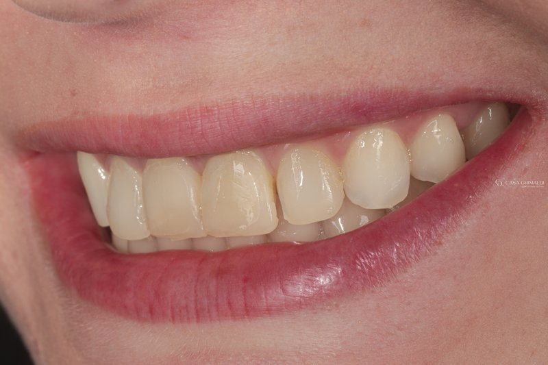 Sorriso antes do tratamento com facetas dentárias
