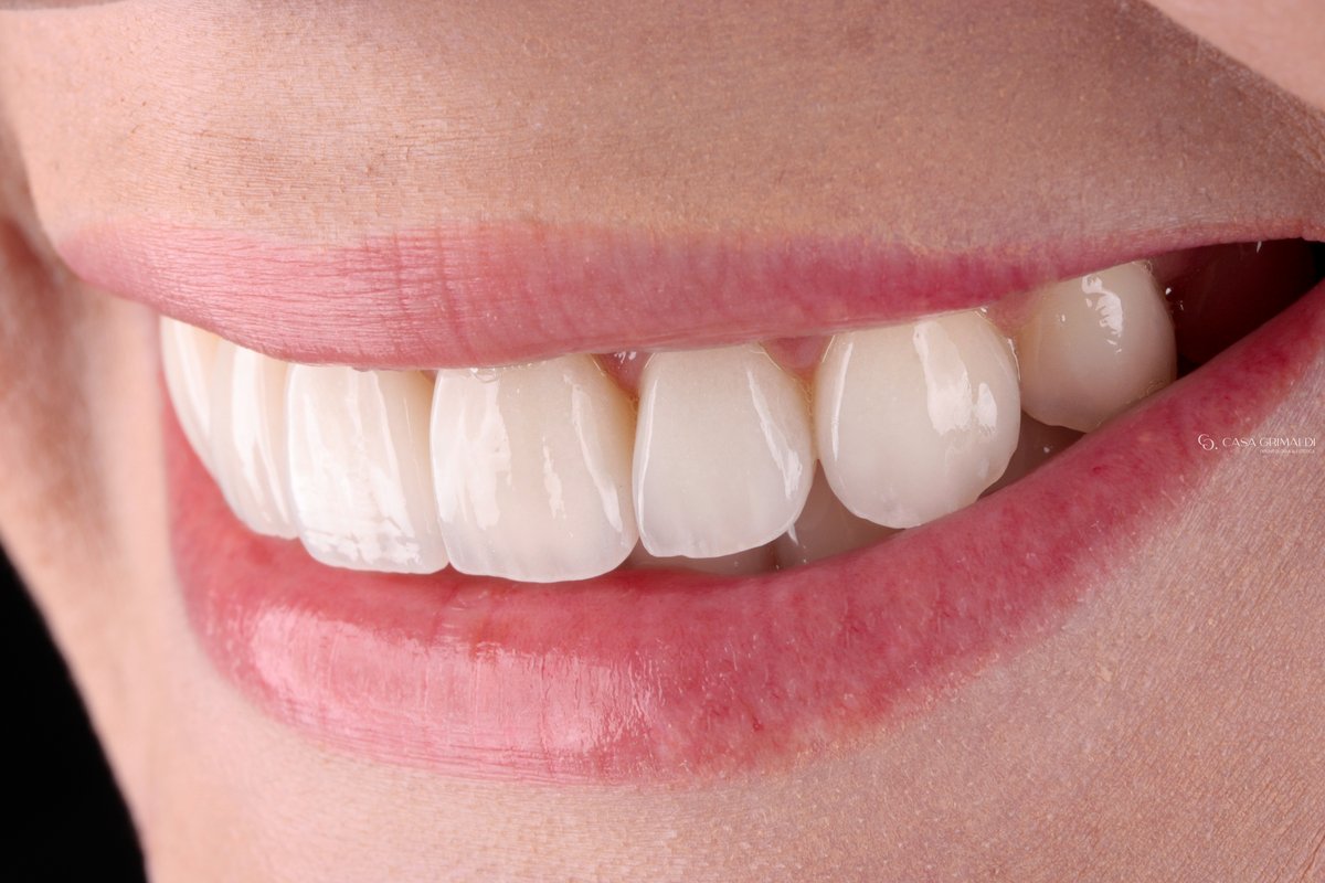 Facetas dentárias em Itapema — resultado em cerâmica de alta translucidez