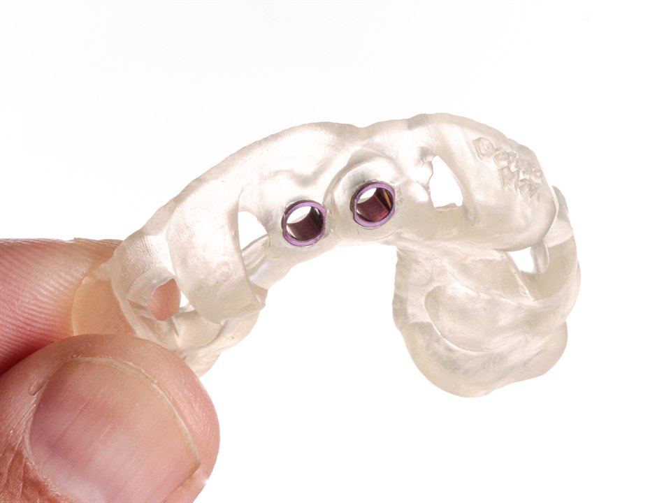 Guia cirúrgico de implante impresso em 3D, usado na cirurgia guiada na Casa Grimaldi, em Itapema