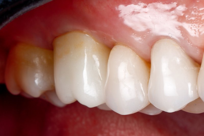 Implante dentário — integração natural com a gengiva ao longo do tempo