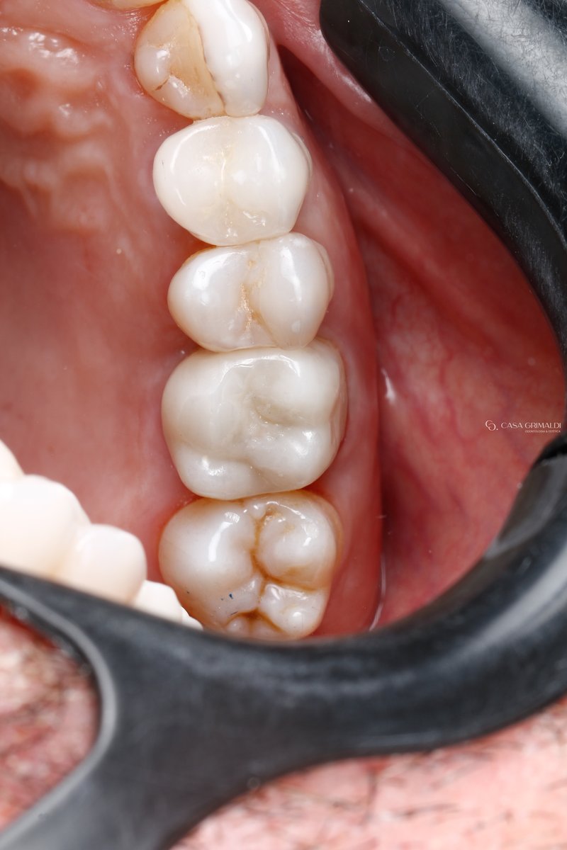 Implante dentário em Itapema — resultado final integrado