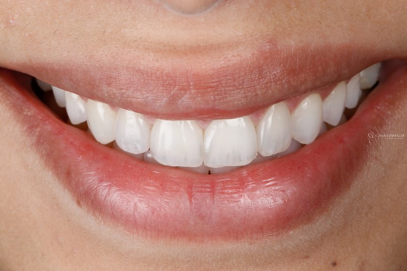 Depois do tratamento — sorriso restaurado