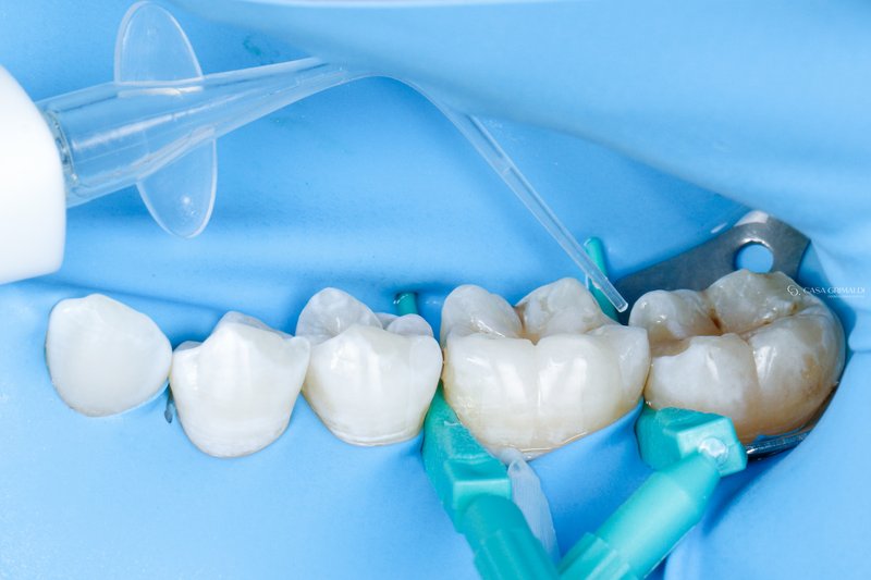 Infiltração resinosa em cárie interproximal