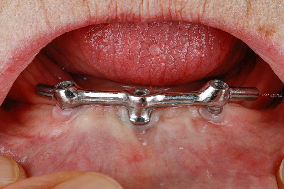 Barra metálica fixada sobre implantes na arcada inferior, com três acessos de parafuso — a base sobre a qual a overdenture encaixa