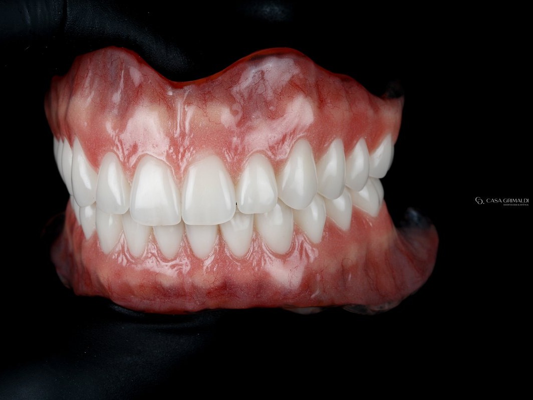 Reabilitação total finalizada vista de frente: prótese total convencional na arcada superior e overdenture sobre implantes na inferior; com as peças prontas, o encaixe não fica aparente