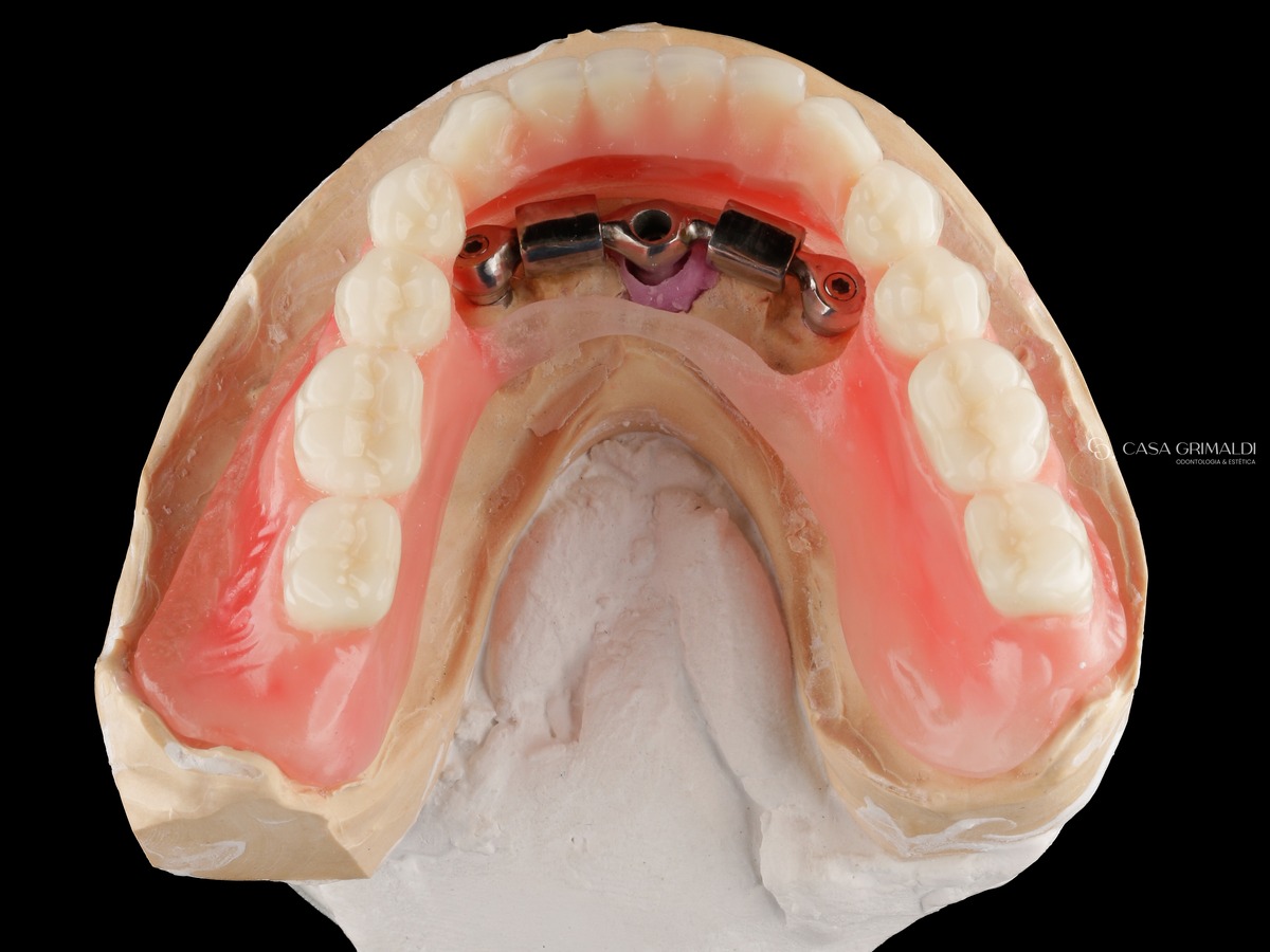 Prova da montagem de dentes em cera de uma overdenture, vista por baixo: as selas metálicas posicionadas sobre a barra