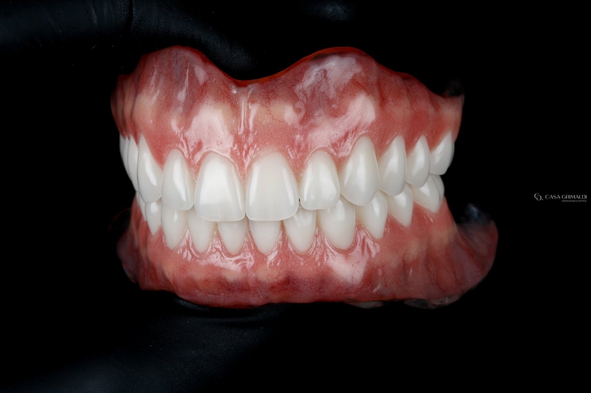 Prótese dentária em Itapema — peça finalizada com gengiva caracterizada