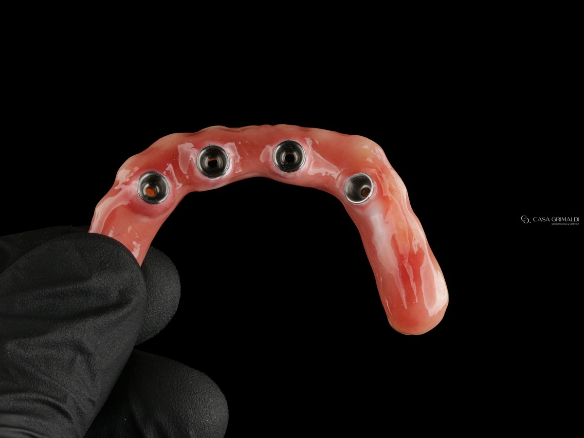 Face interna de uma prótese fixa sobre implantes, com os quatro cilindros de conexão parafusados