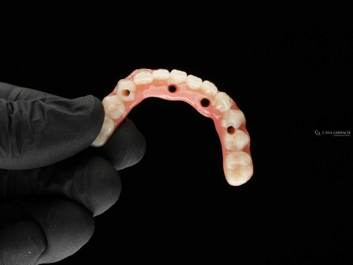 Prótese fixa sobre implantes vista por cima, com os quatro orifícios de acesso aos parafusos