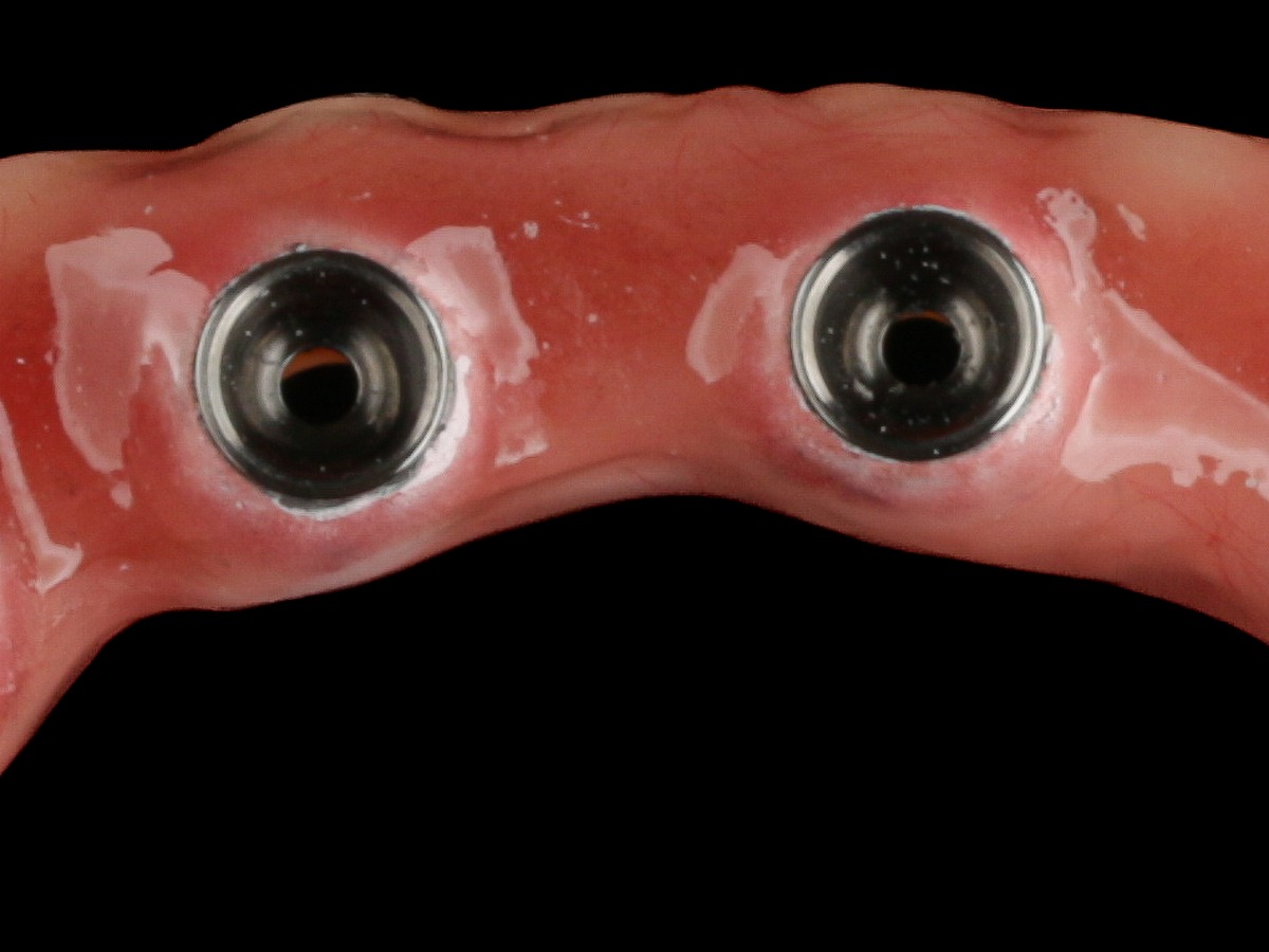 Detalhe de duas conexões parafusadas na face interna de uma prótese fixa sobre implantes