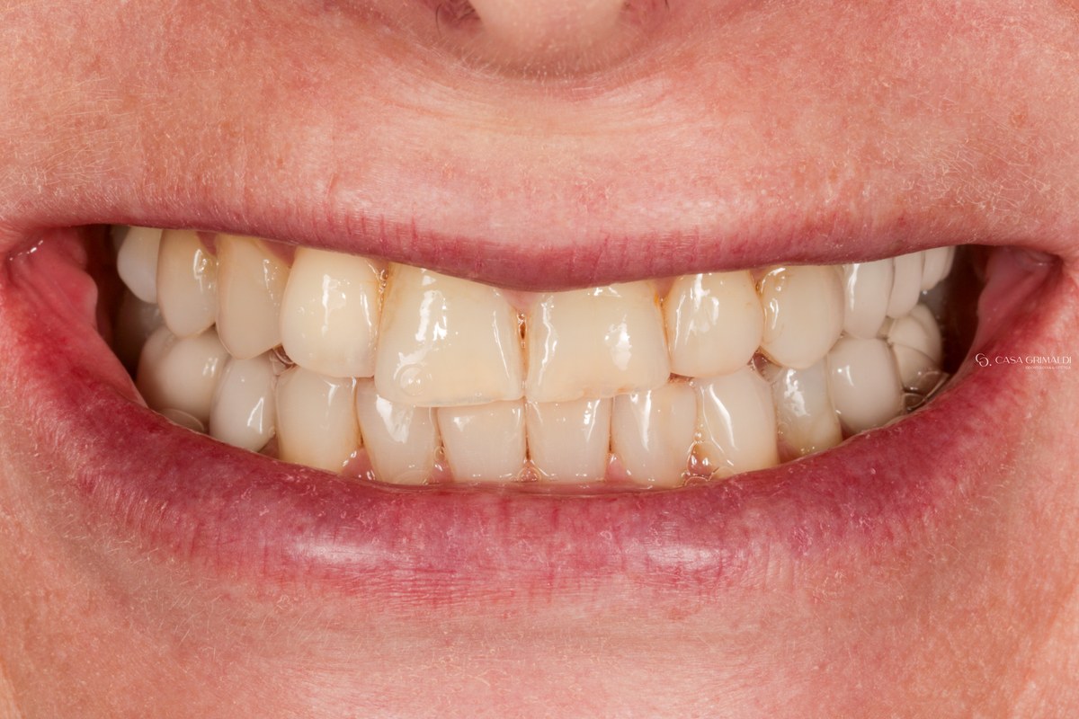 Sorriso antes do tratamento de reabilitação oral na Casa Grimaldi