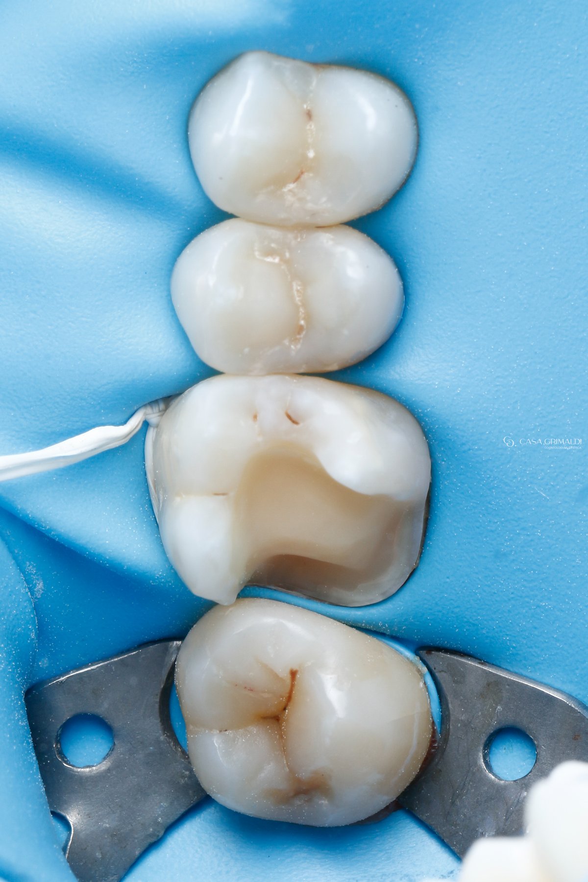 Restauração cerâmica em Itapema — peça produzida em consultório com tecnologia CEREC
