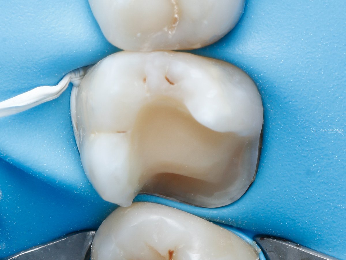 Restauração em cerâmica sob isolamento absoluto, com o dente em campo limpo, isolado e seco, em caso da Casa Grimaldi, na Meia Praia, Itapema