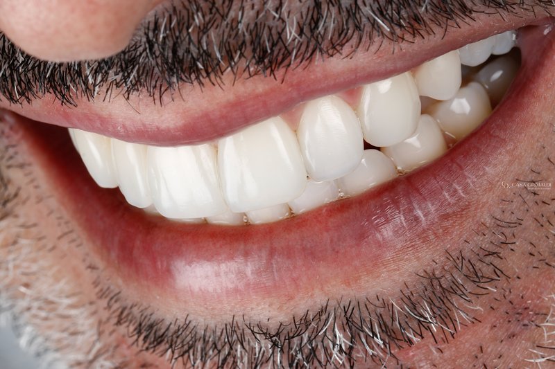 Restauração em resina composta — detalhe