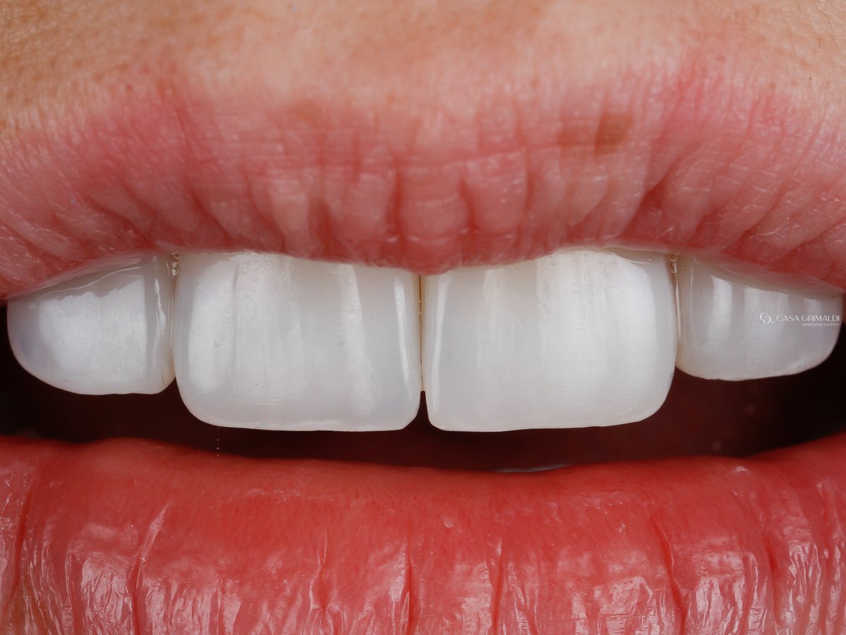 Dente anterior restaurado em resina composta em caso da Casa Grimaldi, na Meia Praia, Itapema