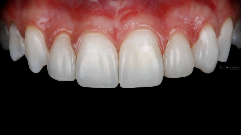 Restauração em resina em dente anterior — resultado estético